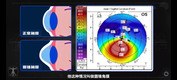 近視錐角膜