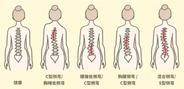 不同程度的脊柱側彎.png