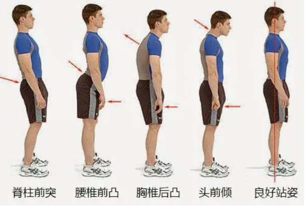 脊柱側彎人體展現的形态